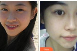 廣西中醫(yī)院第一附屬醫(yī)院美膚激光整形美容科李昌儀整形價格表附鼻部綜合案例展示