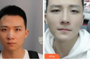 廣西醫(yī)科大學第一附屬醫(yī)院整形美容科王潤秀整形價格表附鼻部綜合案例展示