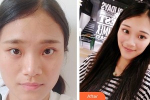 武警廣西總隊醫(yī)院醫(yī)學整形美容中心韋炳朝整形價格表附鼻部綜合案例展示