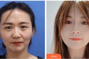 武警廣西總隊醫(yī)院醫(yī)學整形美容中心趙元整形價格表附埋線雙眼皮案例展示