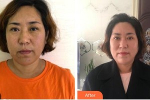 廣西中醫(yī)藥大學附屬瑞康醫(yī)院整形美容中心李莉整形價格表附切開雙眼皮案例展示