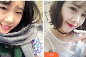 廣西中醫(yī)藥大學附屬瑞康醫(yī)院整形美容中心林忠整形價格表附切開雙眼皮案例展示