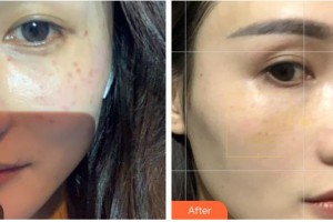 武警廣西總隊醫(yī)院醫(yī)學(xué)整形美容中心隋長清整形價格表附激光祛斑案例展示