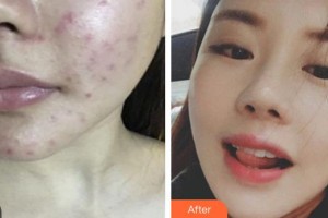 武警廣西總隊醫(yī)院醫(yī)學整形美容中心董小飛整形價格表附紅藍光祛痘案例展示