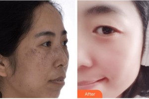 廣西科技大學第一附屬醫(yī)院骨傷整形科楊建德整形價格表附激光祛斑案例展示