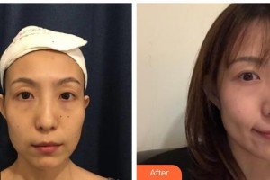 武警廣西總隊醫(yī)院醫(yī)學(xué)整形美容中心雷素龍整形價格表附去痘印痘坑案例展示