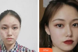 廣西愛思特整形外科醫(yī)院趙彩明整形價格表附紅藍(lán)光祛痘案例展示