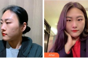 廣西醫(yī)科大學第一附屬醫(yī)院整形美容科蒙誠躍整形價格表附清潔祛痘案例展示