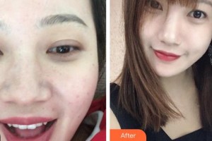 廣西東方整形美容醫(yī)院韋婷整形價格表附激光祛斑案例展示