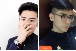 武警廣西總隊醫(yī)院醫(yī)學整形美容中心向宏偉整形價格表附鼻部綜合案例展示