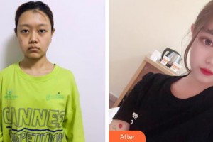 廣西愛思特整形外科醫(yī)院林泉整形價格表附埋線提升案例展示