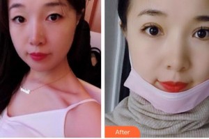 廣西來賓愛爾眼科醫(yī)院肖瀟整形價格表附眼部綜合案例展示