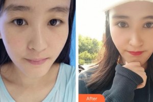 廣西來賓愛爾眼科醫(yī)院謝耀元整形價格表附切開雙眼皮案例展示