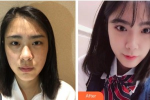 柳州紅十字會(huì)眼科醫(yī)院陽橋生整形價(jià)格表附切開雙眼皮案例展示