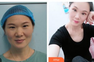 柳州愛爾眼科醫(yī)院黃明海整形價(jià)格表附切開雙眼皮案例展示