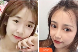 柳州紅十字會(huì)眼科醫(yī)院榮德彥整形價(jià)格表附切開雙眼皮案例展示