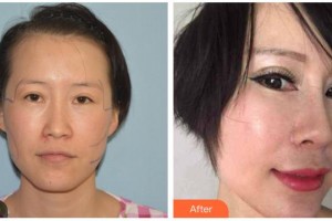 柳州紅十字會眼科醫(yī)院鄧秋瓊整形價格表附切開雙眼皮案例展示