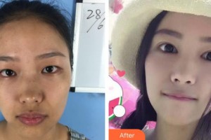 柳州愛爾眼科醫(yī)院黃明漢整形價(jià)格表附眼部綜合案例展示