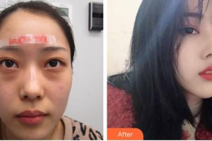 柳州愛爾眼科醫(yī)院王冬梅整形價(jià)格表附眼部修復(fù)案例展示