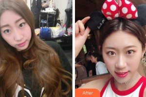 柳州市柳鐵中心醫(yī)院燒傷整形外科龍昕整形價(jià)格表附切開雙眼皮案例展示