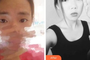 柳州市柳鐵中心醫(yī)院燒傷整形外科林嘉昕整形價(jià)格表附切開雙眼皮案例展示