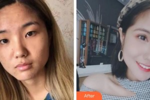 柳州紅十字會(huì)眼科醫(yī)院譚顯里整形價(jià)格表附眼部綜合案例展示