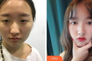 柳州紅十字會(huì)眼科醫(yī)院范俊整形價(jià)格表附眼部綜合案例展示