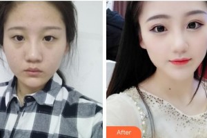 柳州市人民醫(yī)院眼科馬翔整形價(jià)格表附眼部綜合案例展示