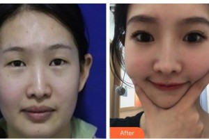 柳州市人民醫(yī)院眼科陶耘整形價(jià)格表附定點(diǎn)雙眼皮案例展示