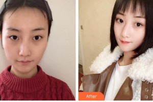 柳州市中醫(yī)醫(yī)院眼科寧作蓮住院醫(yī)師整形價(jià)格表附定點(diǎn)雙眼皮案例展示