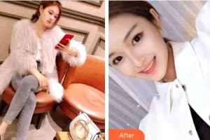 柳州紅十字會(huì)眼科醫(yī)院黃紅波整形價(jià)格表附切開雙眼皮案例展示