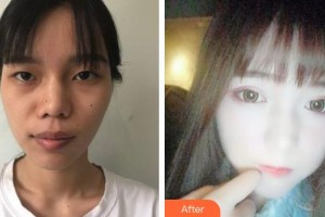 柳州市中醫(yī)醫(yī)院眼科李靜波整形價(jià)格表附眼部綜合案例展示