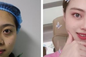 柳州市中醫(yī)醫(yī)院眼科唐柳蘋整形價(jià)格表附激光去眼袋案例展示