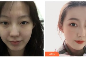 柳州市中醫(yī)醫(yī)院眼科萬小波整形價(jià)格表附眼部綜合案例展示