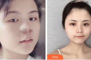 柳州市人民醫(yī)院眼科張曉湄整形價(jià)格表附切開雙眼皮案例展示