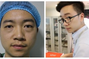 柳州愛爾眼科醫(yī)院陽昇整形價(jià)格表附激光去眼袋案例展示