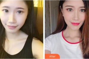 桂林醫(yī)學(xué)院第二附屬醫(yī)院眼科秦程整形價(jià)格表附切開雙眼皮案例展示