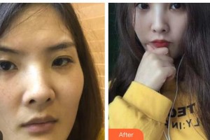 桂林醫(yī)學(xué)院第二附屬醫(yī)院眼科覃蓓整形價(jià)格表附眼部綜合案例展示