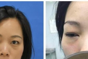 桂林醫(yī)學(xué)院第二附屬醫(yī)院眼科王莉整形價(jià)格表附激光去眼袋案例展示