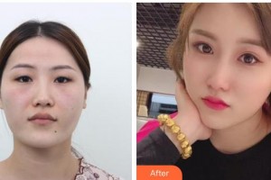 桂林市人民醫(yī)院眼科廖偉整形價(jià)格表附切開(kāi)雙眼皮案例展示