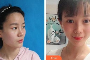 桂林市人民醫(yī)院眼科李毅宏整形價(jià)格表附眼部綜合案例展示