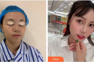 桂林市人民醫(yī)院眼科鐘旭整形價(jià)格表附眼部綜合案例展示