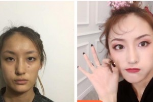 梧州市紅十字會醫(yī)院燒傷整形科陳燕圖整形價格表附定點雙眼皮案例展示