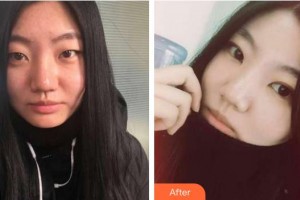 梧州市工人醫(yī)院眼科楊勝信整形價格表附埋線雙眼皮案例展示