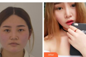 梧州市工人醫(yī)院眼科賀瑋整形價格表附切開雙眼皮案例展示