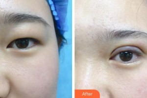 梧州市工人醫(yī)院眼科魏艷飛整形價格表附眼部綜合案例展示