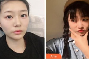 梧州市工人醫(yī)院眼科李沂鋼整形價格表附激光去眼袋案例展示