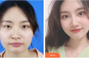 梧州市工人醫(yī)院眼科趙夏海整形價格表附切開雙眼皮案例展示