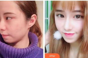 北海韓美醫(yī)療美容門診部鐘舉然整形價格表附眼部綜合案例展示