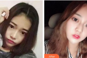 北海韓美醫(yī)療美容門診部劉秀艷整形價格表附眼部綜合案例展示